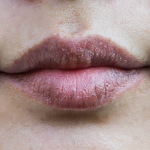 bibir kering saat puasa akibat dehidrasi